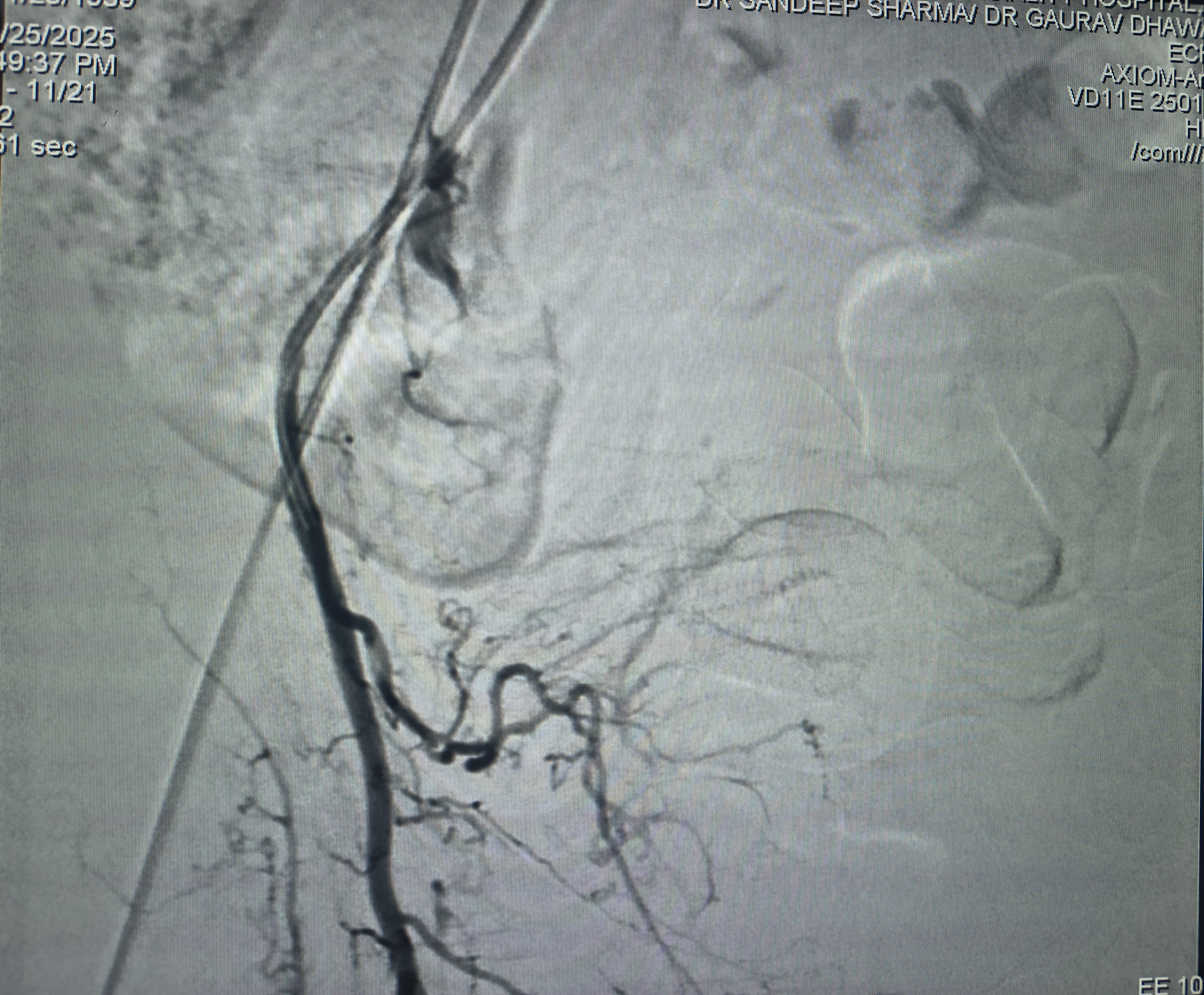 Right Prostatic Artery arising from the Obturator Artery